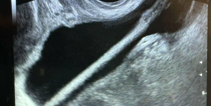 В Подмосковье врачи удалили из мочевого пузыря женщины карандаш