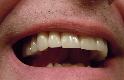 Электрик откусил ухо товарищу за доносительство