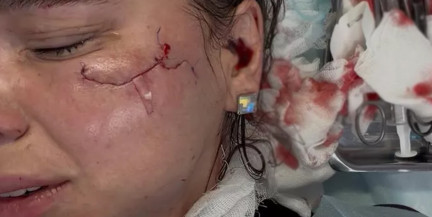 Королеве красоты из Кирова изуродовали лицо в клубе