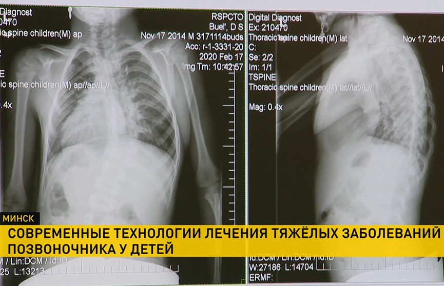 Уникальную операцию на позвоночнике ребенка провели в Минске