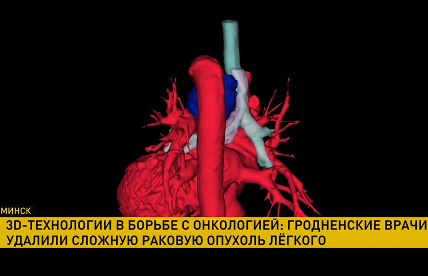 Первая операция в 3D: в Гродно врачи спасли жизнь пациенту с опухолью легких