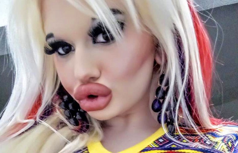 Ради внешности Барби студентка из Болгарии увеличила губы 15 раз