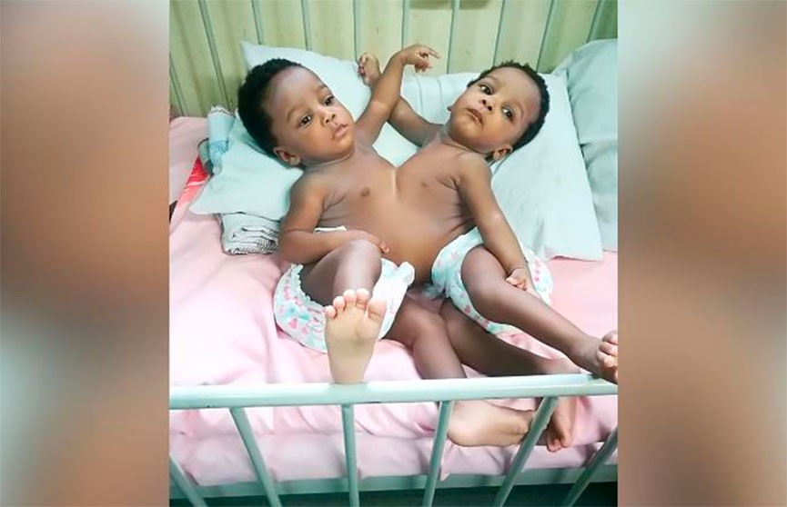Команда из 78 медработников 13 часов разделяла сиамских близнецов из Нигерии