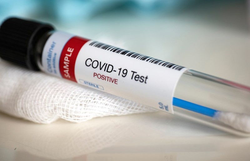 Минздрав: тесты на антитела к COVID-19 к концу апреля будут доступны в Беларуси
