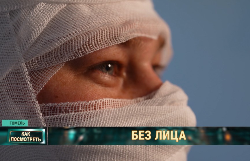Белорусские хирурги провели уникальную операцию по пересадке лица человеку, пострадавшему в ДТП