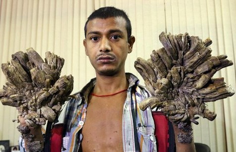 «Человек-дерево» из Бангладеш попросил врачей ампутировать ему руки