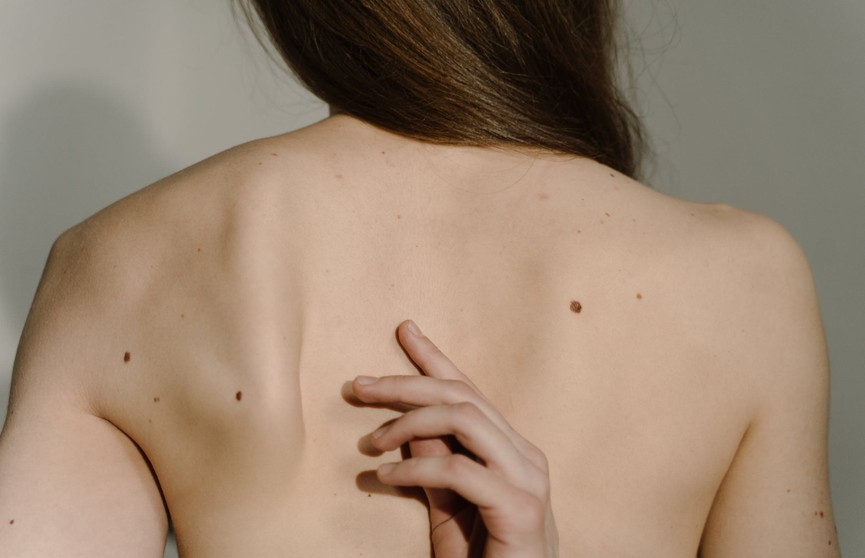 Дерматолог рассказала, какие новообразования на коже говорят о раке кишечника