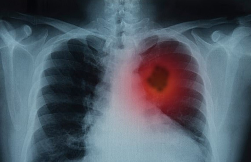 Лечение рака лёгких с помощью горячей иглы начали применять британские врачи: опухоль уничтожают за 30 минут