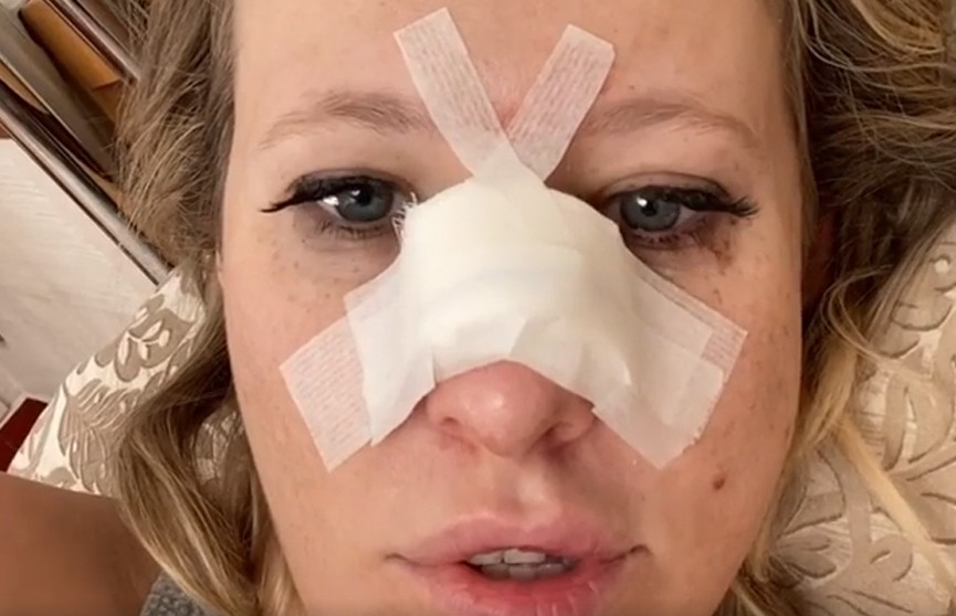Ксения Собчак сломала нос и объявила конкурс на «самую смешную версию»