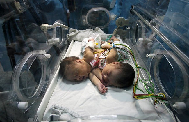Одно сердце на двоих: необычные сиамские близнецы родились в Индии