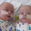 Самые маленькие в мире близнецы родились в Британии